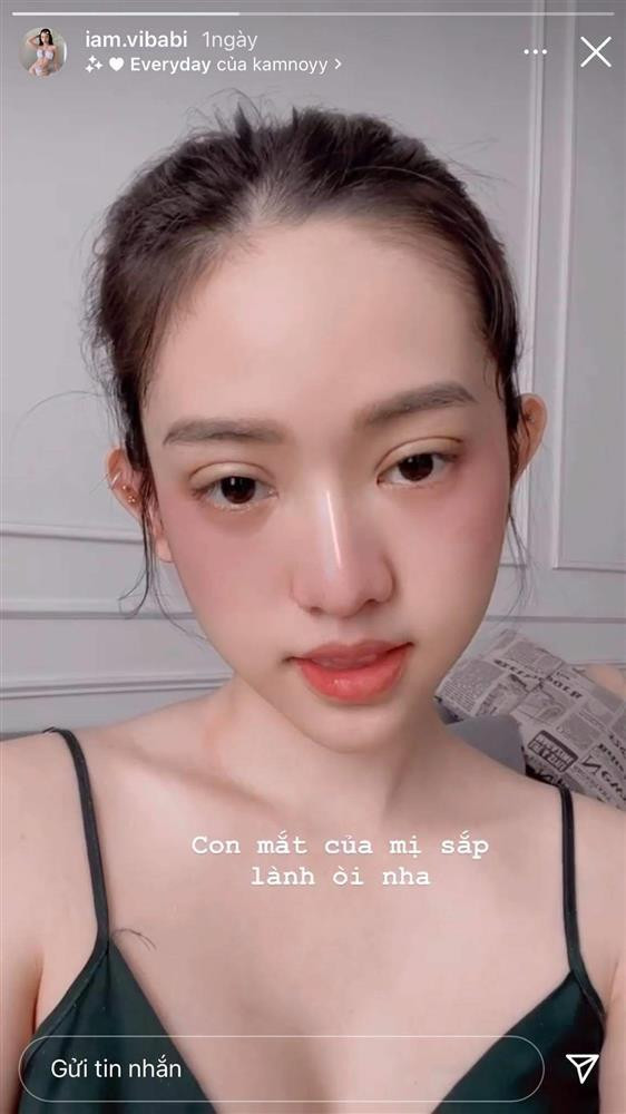 Trên story Instagram, gái xinh 9x đăng ảnh cận mặt cùng chia sẻ: "Con mắt của mị sắp lành rồi nha", kèm theo bức ảnh phần mí mắt sưng húp.