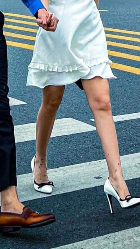 Theo đó trong một bức ảnh được đăng tải, Midu và Kiều Minh Tuấn đang nắm tay tình tứ bước qua đường, tuy nhiên netizen không khỏi rời mắt trước đôi chân đầy sẹo, lốm đốm rất nhiều chỗ mất thẩm mỹ của Midu.