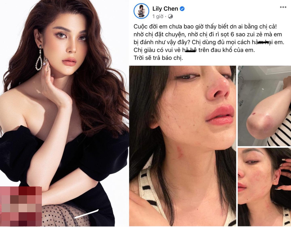 Trưa 2/11, Lily Chen có bài đăng gây chú ý trên trang cá nhân. Cô tung loạt ảnh bầm dập từ mặt tới thân do bị hành hung.