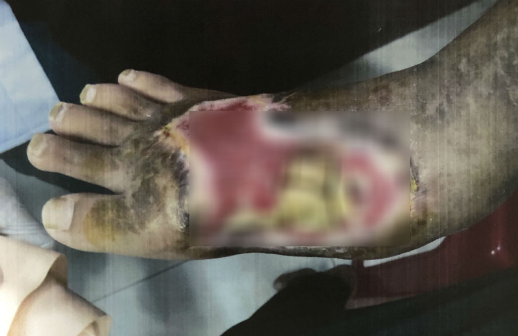 Bàn chân phải bé gái bị hoại tử, lòi xương ra ngoài.