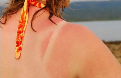 Tiếp xúc lâu với ánh nắng, da dễ bị cháy nắng.