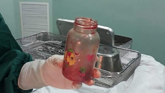 Nguy kich vi nhet binh sua vao hau mon chua thoai hoa cot song