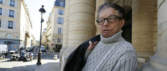 Ông Jerome Hamon với khuôn mặt được cấy ghép lần đầu. Ảnh: Le Point