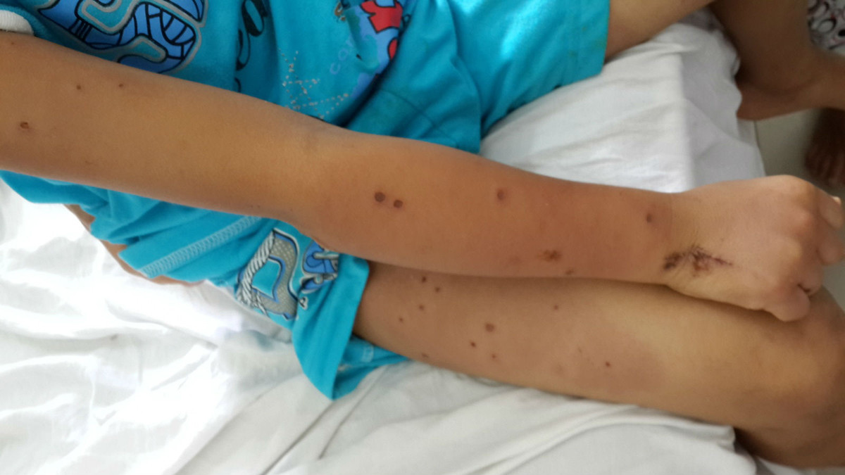 Vi sao bi ong vo ve dot co the tu vong sau 15 phut?-Hinh-2