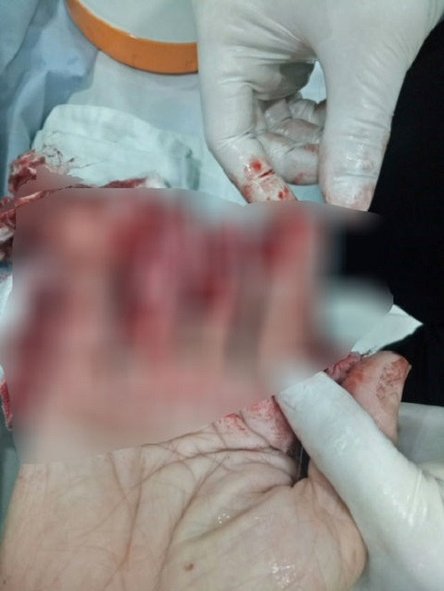 Các bác sĩ không thể nối lại ngón tay do người nhà bệnh nhân bảo quản sai cách. Ảnh: Người lao động.