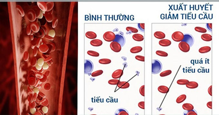 Giảm tiểu cầu: Một trong những tác dụng phụ nghiêm trọng nhất của hóa trị là giảm tiểu cầu (hoặc số lượng tiểu cầu thấp). Nếu số lượng tiểu cầu ít hơn 30.000 trong khi điều trị, điều này có thể ảnh hưởng đến đông máu và nó cũng sẽ làm cho người bệnh chảy máu bạn kéo dài.