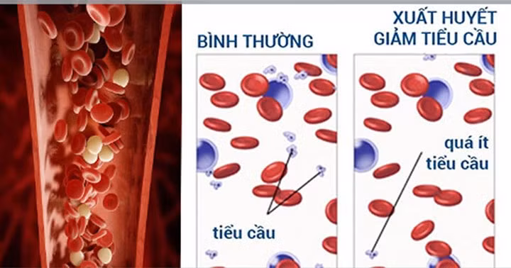 Giảm tiểu cầu: Một trong những tác dụng phụ nghiêm trọng nhất của hóa trị là giảm tiểu cầu (hoặc số lượng tiểu cầu thấp). Nếu số lượng tiểu cầu ít hơn 30.000 trong khi điều trị, điều này có thể ảnh hưởng đến đông máu và nó cũng sẽ làm cho người bệnh chảy máu bạn kéo dài.