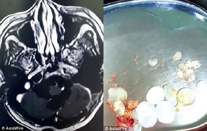 Bác sỹ phát hiện hàng chục trứng sán dây trong đầu người đàn ông ăn thịt sống.