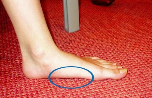  6. Lòng bàn chân phẳng Nhiều chị em thường tự ti với đôi bàn chân của mình sao phẳng phiu và xấu xí quá. Đặc biệt là mỗi lần đi mua giày dép, thấy mấy cô nhân viên nhìn với ánh mắt soi mói khiến nhiều người e ngại. Nhưng ít ai biết lòng bàn chân phẳng giúp cơ thể giảm chấn thương đùi. 