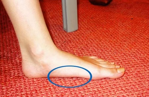  6. Lòng bàn chân phẳng Nhiều chị em thường tự ti với đôi bàn chân của mình sao phẳng phiu và xấu xí quá. Đặc biệt là mỗi lần đi mua giày dép, thấy mấy cô nhân viên nhìn với ánh mắt soi mói khiến nhiều người e ngại. Nhưng ít ai biết lòng bàn chân phẳng giúp cơ thể giảm chấn thương đùi. 