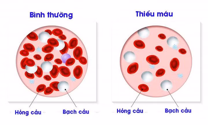 Thiếu máu: Thiếu máu có thể dẫn đến mệt mỏi và buồn ngủ. Hóa trị tổn thương các tế bào máu đỏ trong cơ thể dẫn đến thiếu máu. Khoảng 70% bệnh nhân trải qua hóa trị liệu bị ảnh hưởng bởi bệnh thiếu máu.