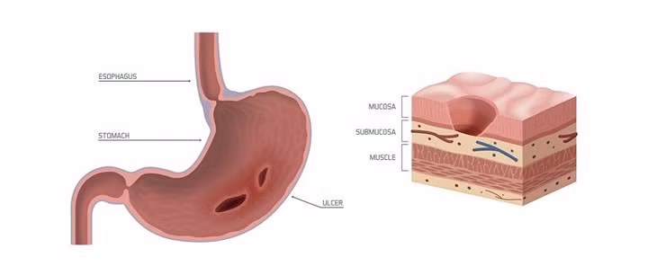 Loét dạ dày là do nhiễm trùng từ vi khuẩn H.plyori: Nó xảy ra khi axit thâm nhập sâu vào niêm mạc dạ dày của bạn, gây ra một vết loét mở. Điều này có thể dẫn đến đau dạ dày, đầy hơi, ợ nóng và buồn nôn.