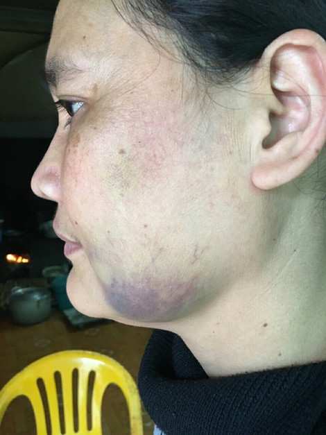 Vết bầm tím sau khi bị bạo hành.