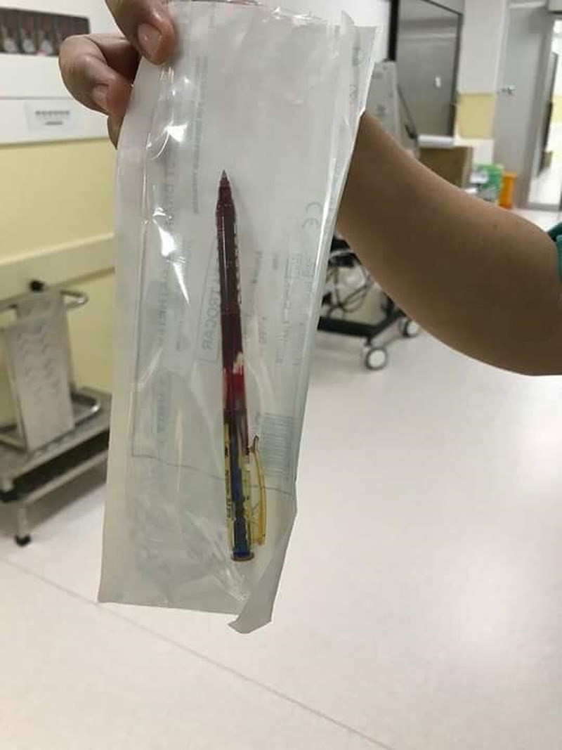 Cây bút bi được lấy ra khỏi ngực bé gái. Ảnh: BV.