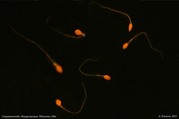 Kết quả khám bệnh cho thấy người đàn ông không có tinh trùng do khối u ở tinh hoàn. (Ảnh minh họa).