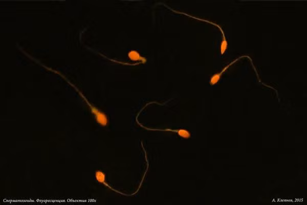 Kết quả khám bệnh cho thấy người đàn ông không có tinh trùng do khối u ở tinh hoàn. (Ảnh minh họa).