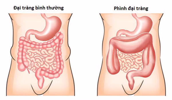 Bệnh phình đại tràng bẩm sinh.