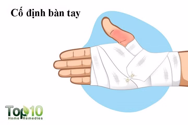Cố định bàn tay: Để giảm đau và sưng bị bong gân, hãy cố định ngón tay cái càng sớm càng tốt. Cố định ngón tay cái ngăn không cho chất lỏng tích tụ, giúp giảm sưng cũng như đau. Nó cũng sẽ ngăn ngừa chấn thương thêm.