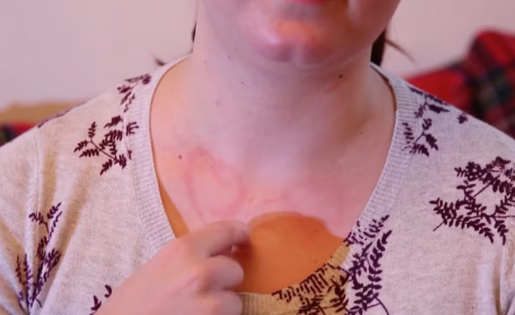  Dị ứng áp lực: Da của người mắc chứng dị ứng này dễ dàng ửng đỏ khi có áp lực tác động lên. Bạn có thể nổi mẩn khắp người khi mặc quần áo chật hay thậm chí là khi lau người sau tắm. Khoảng 4% dân số thế giới mắc chứng dị ứng này. Ảnh: Businessinsider.