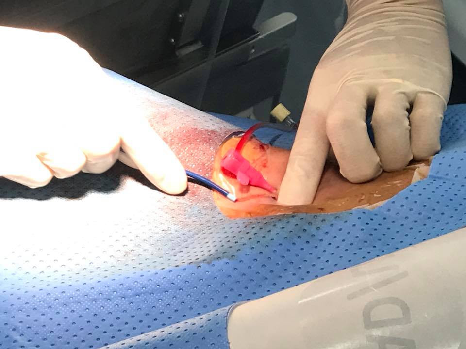 Điều trị thành công bệnh nhi tim mạch bẩm sinh bằng máy DSA - Hình 3 Dieu tri thanh cong benh nhi tim mach bam sinh bang may DSA-Hinh-3