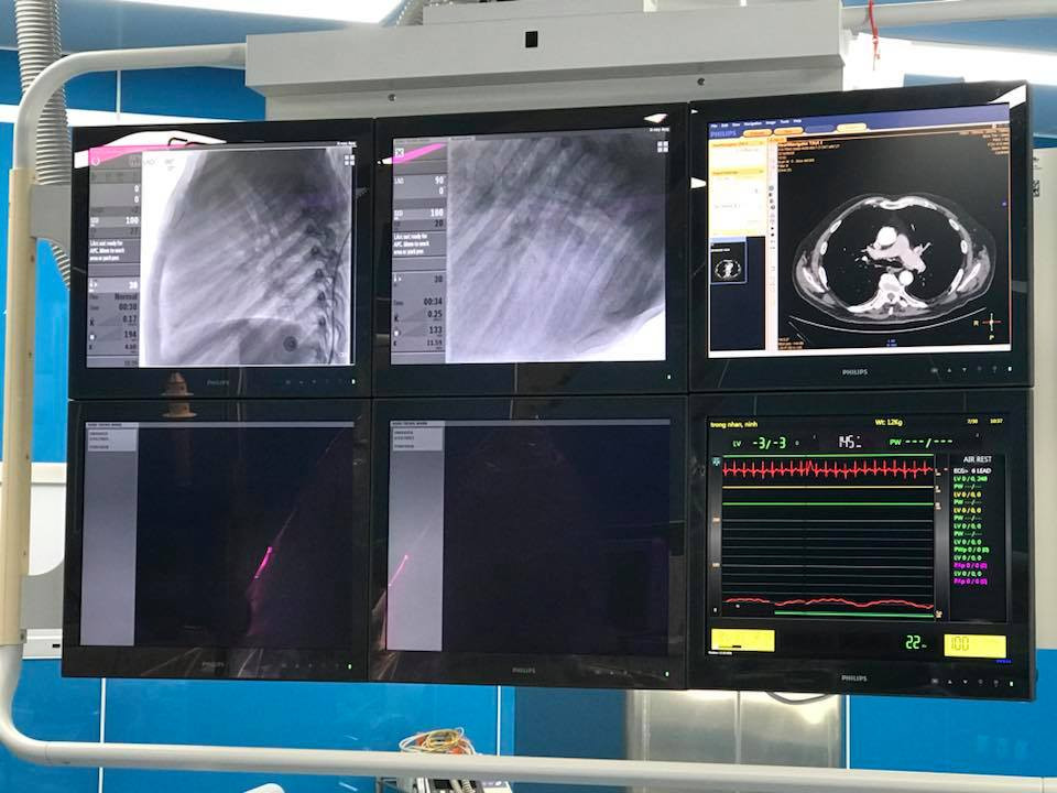 Điều trị thành công bệnh nhi tim mạch bẩm sinh bằng máy DSA - Hình 4 Dieu tri thanh cong benh nhi tim mach bam sinh bang may DSA-Hinh-4