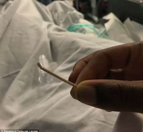 Chiếc que tránh thai lấy ra từ động mạch phổi của cô Deborah.