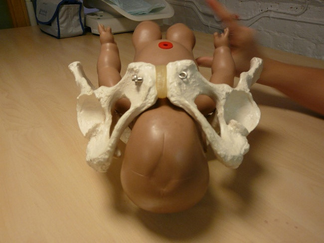 Quan niệm 7: Hông rộng giúp bạn dễ sinh hơn. Hông to hơn phần lớn là do xương chậu - phần lớn và cao nhất của hông. Nhưng trên thực tế, kích thước của xương chậu không liên quan gì đến kích thước của đường dẫn sinh. Yếu tố quyết định ở đây là hình dáng và kích thước của lỗ tròn ở giữa xương chậu. Nó được gọi là đầu vào khung chậu và có thể giống nhau cho dù bạn có hông rất lớn hay rất nhỏ.