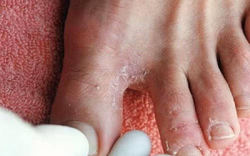 6 bai thuoc dan gian chua nuoc an chan tai nha cho nguoi dan vung lu