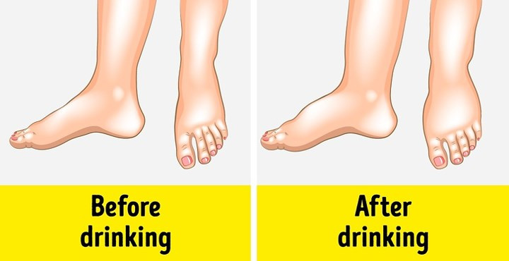 Sổ mũi: Các triệu chứng như hắt hơi, mũi bị tắc và khó thở như cảm lạnh thông thường. Tuy nhiên, nguồn gốc của các triệu chứng thực sự có thể do cơ thể không dung nạp rượu. Có một số lượng lớn các mao mạch ở niêm mạc mũi. Khi tiếp xúc với ethanol trong rượu, phù nề phát triển gây khó thở và gây cảm giác nghẹt mũi.