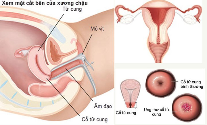 Tổn thương cổ tử cung: Cổ tử cung bị giãn nở mạnh để chấm dứt thai kỳ. Điều này đôi khi có thể dẫn đến tổn thương ở mô cổ tử cung. Vấn đề nghiêm trọng này thậm chí có thể dẫn đến việc những người phụ nữ dễ gặp rủi ro khi mang thai trong tương lai.