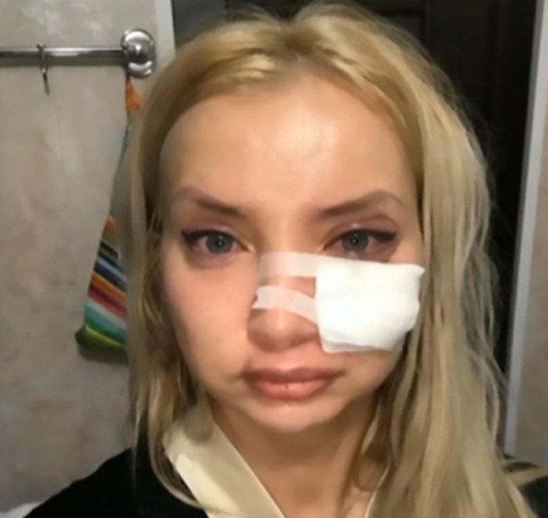 Cô gái trẻ ngay lập tức phải nhập viện cầu cứu sự giúp đỡ của các bác sĩ vì khuôn mặt gặp biến chứng do tiêm filler rẻ tiền.