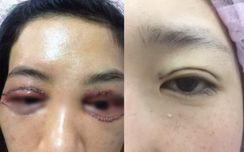 Khách hàng này nhận phải cái kết thảm sau khi phẫu thuật thẩm mỹ nhấn và cắt mí mắt. Không chỉ vẻ ngoài trông sợ hãi mà bên trong cũng bị tổn thương, ảnh hưởng tới tầm nhìn của mắt. 