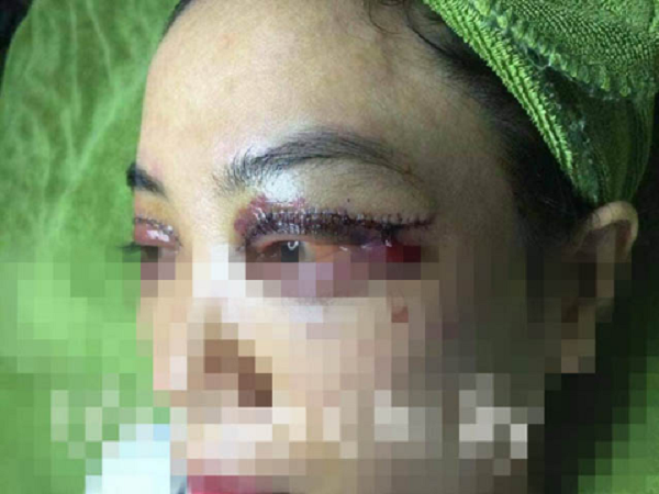 Điển hình như cô gái này, sau khi thực hiện nhấn mí, mắt cô gái hóa thành chân rết, chảy máu và thâm tím.