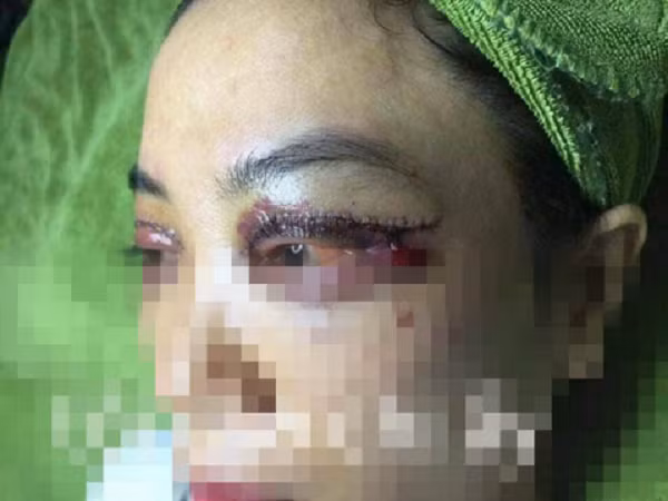 Điển hình như cô gái này, sau khi thực hiện nhấn mí, mắt cô gái hóa thành chân rết, chảy máu và thâm tím.