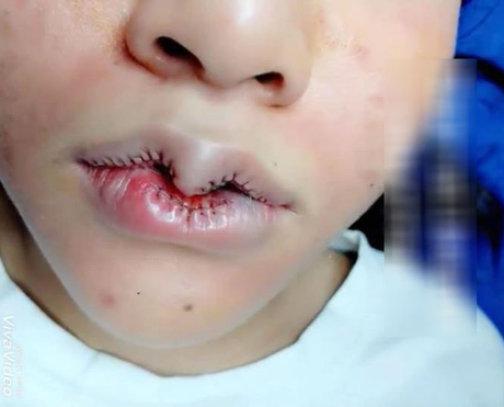 Cắt môi trái tim lại bị dân mạng ví như chiếc mỏ chim.