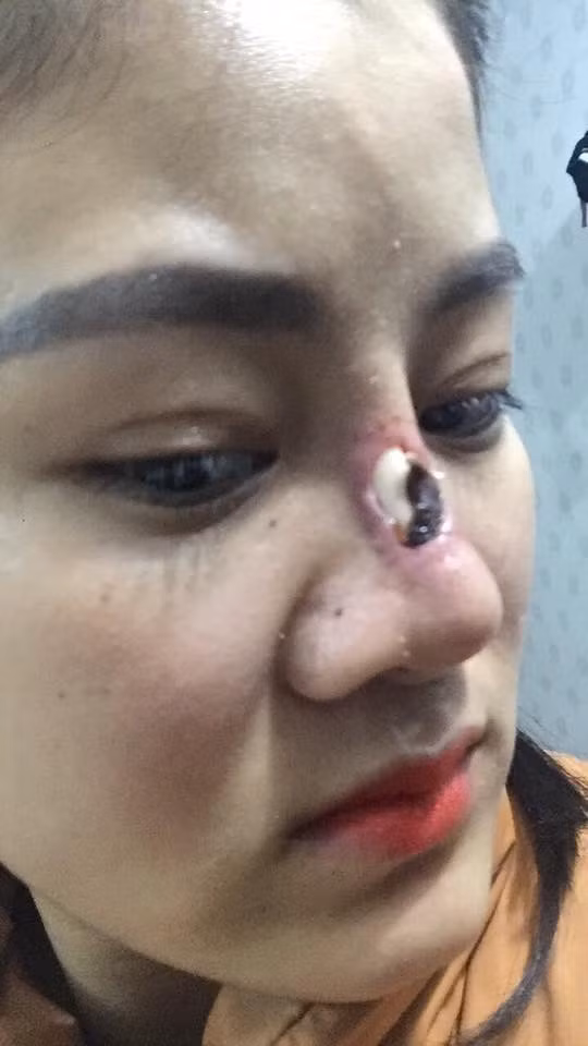 Thực hiện nâng mũi với giá 7 triệu đồng dưới bàn tay của chủ thẩm mỹ sinh năm 2001 ở Bắc Giang, cô gái này nhận cái kết đắng. Hậu phẫu, mũi của cô có hiện tượng sưng tụ máu, lòi sụn đau đớn gây nguy hiểm.