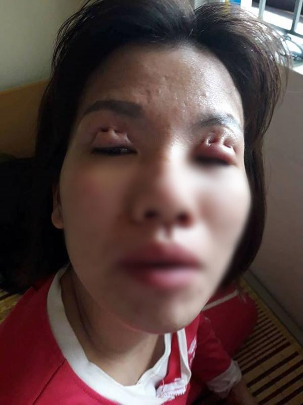 Trong năm qua, cộng đồng mạng liên tục hoang mang khi chứng kiến nhiều trường hợp phẫu thuật thẩm mỹ cắt mí, nhấn mí mắt hỏng. Đôi mắt là cửa sổ tâm hồn mà cứ như khâu quần áo vậy.