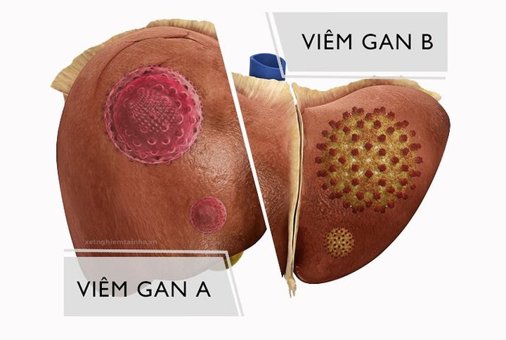 Viêm gan là một bệnh nhiễm virus ảnh hưởng đến hàng ngàn người trên thế giới. Các loại virus gan khác nhau gây ra các loại bệnh khác nhau, bao gồm viêm gan A, B, C, D và E. Viêm gan A và E là do ăn thực phẩm bị ô nhiễm hoặc uống nước bị ô nhiễm. Viêm gan B, C và D lây bệnh thông qua truyền máu, quan hệ tình dục và trong khi sinh. Viêm gan cũng có thể là do uống rượu quá mức và các bệnh tự miễn dịch.