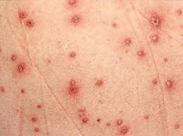 Thủy đậu được cho là lành tính trừ khi biến chứng.