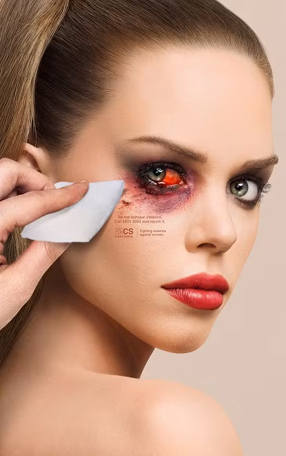 Kết quả, vùng mắt này của người phụ nữ đã bị viêm nhiễm, rất có khả năng dẫn đến mù vĩnh viễn. Các bác sỹ đã mất 90 phút để phẫu thuật loại bỏ lớp cặn, tuy nhiên, ca phẫu thuật vẫn để lại sẹo vĩnh viễn.