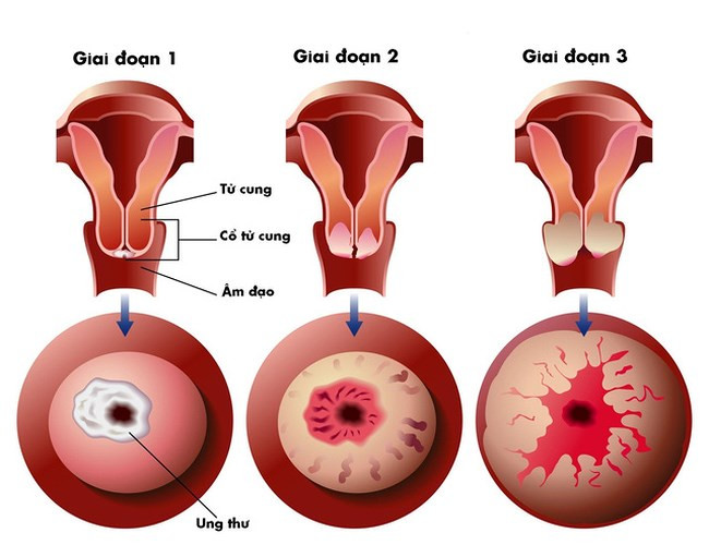 Ung thư cổ tử cung: Theo Tổ chức Y tế Thế giới, ung thư cổ tử cung là ung thư phổ biến thứ tư và là căn bệnh giết người thầm lặng hàng đầu ở phụ nữ, đặc biệt là ở các nước đang phát triển. Bệnh ung thư này xảy ra ở các tế bào cổ tử cung và thường không có triệu chứng nào trong giai đoạn đầu. Nếu không được chẩn đoán sớm, ung thư cổ tử cung sẽ sớm lan đến bàng quang, gan, ruột hoặc phổi. Ở giai đoạn sau, người ta có thể bị đau vùng chậu hoặc chảy máu âm đạo.