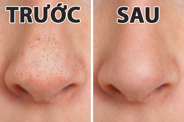  8. Làm mặt nạ lột mụn đầu đen Mặt nạ lột mụn đầu đen sẽ giúp cả khuôn mặt bạn sáng bừng lên và làm sạch sâu lỗ chân lông của bạn. Cách làm: Trộn ½ thìa cà phê gelatin không mùi cùng 1 thìa nước lọc cùng ½ thìa cà phê than hoạt tính lại với nhau. Sau khi trộn đều, bôi lên phần bạn muốn lột mụn. Đợi đến khi mặt nạ hoàn toàn khô, lột mặt nạ theo hướng từ dưới lên trên. Các mụn đầu đen sẽ bị bóc hết ra và da bạn nhìn sáng hẳn lên.