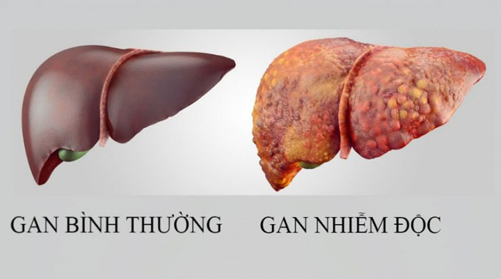 Nhiễm độc gan: Hóa trị liên quan đến một số loại thuốc có thể gây tổn thương nghiêm trọng cho gan của bạn. Các loại thuốc này là các độc tố để tiêu diệt tế nào ung thư nhưng nó cũng có thể tác động trực tiếp đến gan.