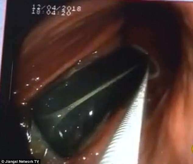 Hình ảnh nội soi lấy bật lửa.