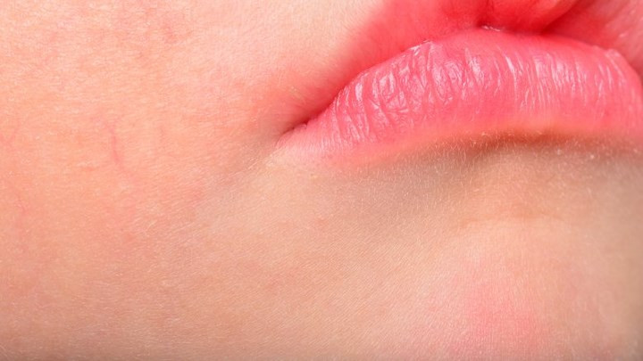 Phản ứng dị ứng: Cũng giống như với bất kỳ một thủ thuật y tế nào, bạn có thể gặp phản ứng dị ứng khi tiêm môi. Nó khá hiếm, nhưng không nên bỏ qua. Các tác dụng phụ nghiêm trọng hơn có thể xảy ra như bầm tím hoặc sưng tấy, sưng dọc vùng tiêm, nhiễm trùng, môi lệch. Chất độn vĩnh viễn có thể gây ra các vấn đề lâu dài.