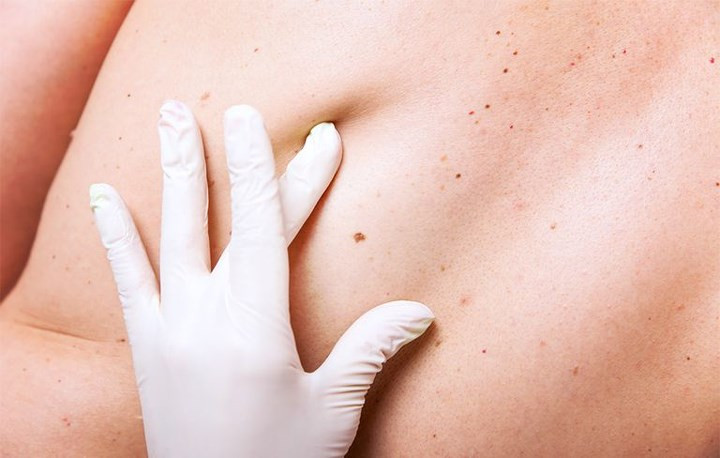 Ung thư da không phải tế bào hắc tố (Nonmelanoma): Ung thư da phát triển chậm ở các lớp trên của da do phơi nhiễm tia cực tím (UV). Một mảng đỏ hoặc vảy trên da hoặc vết thương trên da không lành lại sau một vài tuần là những dấu hiệu đầu tiên của ung thư da không phải tế bào hắc tố.