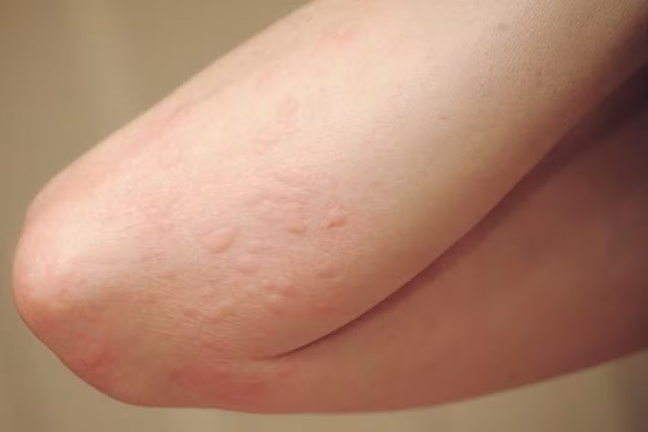 Nguyên nhân dị ứng da: Việc sử dụng gel lô hội trong một thời gian dài có thể gây dị ứng da như viêm, phát ban và đỏ mí mắt. Các tác dụng phụ khác trên da bao gồm da khô, cứng, có các đốm đỏ. Hơn nữa, bôi gel và đi ra ngoài nắng có thể gây phát ban và kích ứng da.