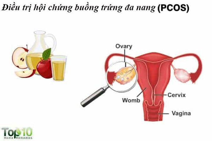 Điều trị hội chứng buồng trứng đa nang (PCOS): Đây là rối loạn nội tiết tố thường gặp nhất ở phụ nữ trong độ tuổi từ 18 đến 44. Để đối phó với PCOS, giấm táo rất hiệu quả. Nó giúp kiểm soát lượng đường trong máu và ngăn cản cơ thể sản xuất quá nhiều insulin. Ít insulin có nghĩa là ít testosterone hơn. Nồng độ hormone testosterone cao là nguyên nhân dẫn đến PCOS.