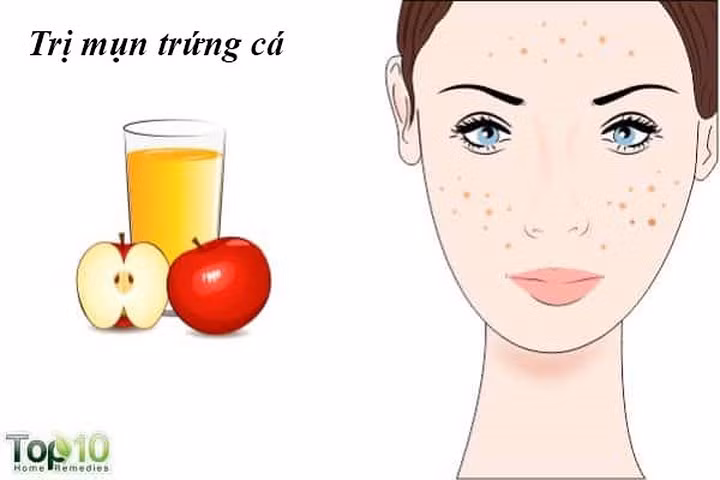 Chữa trị mụn trứng cá: Mụn trứng cá là một vấn đề thường gặp ở phụ nữ. Các axit alpha hydroxy trong giấm táo giúp loại bỏ các tế bào da chết làm tắc nghẽn các lỗ chân lông. Giữ các lỗ chân lông trên da sạch vi khuẩn, dầu và các hạt bụi bẩn là bí quyết để làn da không có mụn. Ngoài ra, nó giúp khôi phục và cân bằng độ pH của da, điều cần thiết để ngăn ngừa mụn trứng cá.