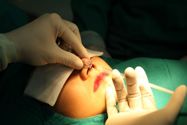 Một trường hợp nâng mũi bằng cách tiêm chất làm đầy Fliller - Ảnh: (minh họa).